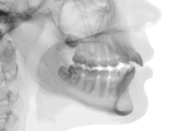 Implantat